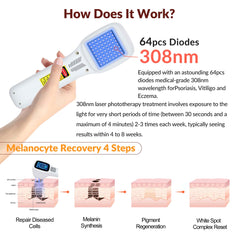 ZJZK 308nm excimer device - Effective Natural Light Therapy for Psoriasis, Vitiligo and Eczema at home